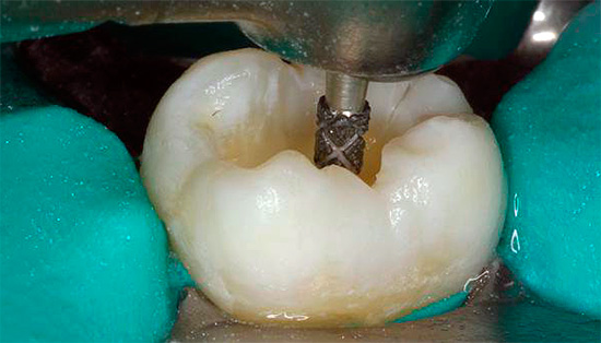 Preparación de los dientes por un taladro.