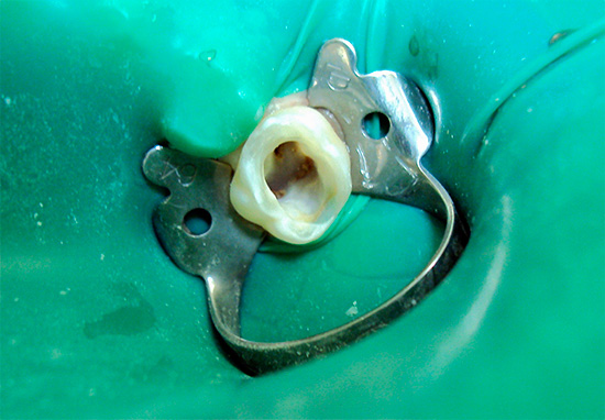 Cofferdam - un pedazo de látex, con el cual el diente se aísla de la cavidad bucal durante las manipulaciones.
