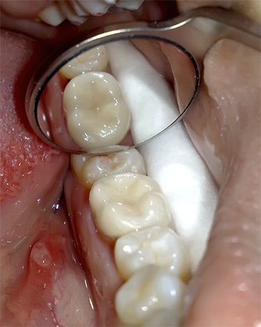 Y así es como se ve un diente de tres canales después del tratamiento de la pulpitis y la instalación de empastes permanentes.