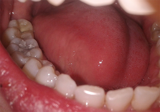 La foto muestra un relleno temporal en el diente (el llamado arsénico).