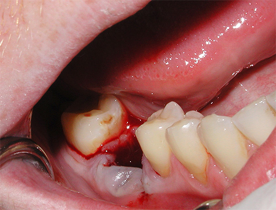 Efter att en tand har dragits ut, sväller kinden upp ofta, men det är ibland svårt för en vanlig person att förstå sig själv om det är normalt eller tvärtom farligt för hälsan.
