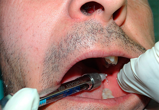 Een gevoel van zwelling van de wang en het tandvlees kan al optreden in het stadium van de injectie van de anesthesie.