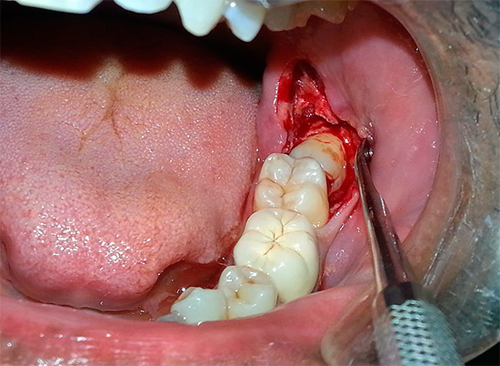 A causa della lesione dei tessuti molli e duri, un processo infiammatorio ed edema si sviluppano vicino al dente estratto.