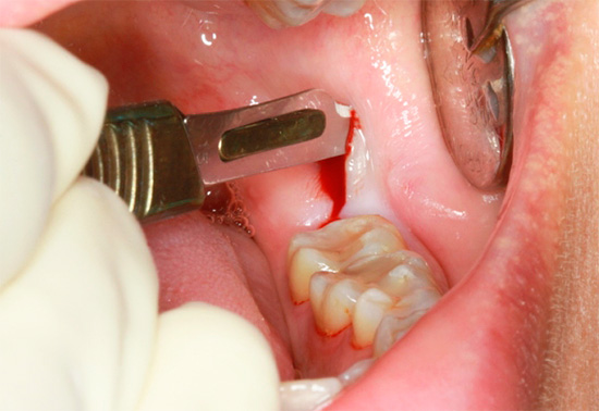 Khi loại bỏ răng khôn bị ảnh hưởng, kẹo cao su mà nó được đặt trước tiên được cắt.