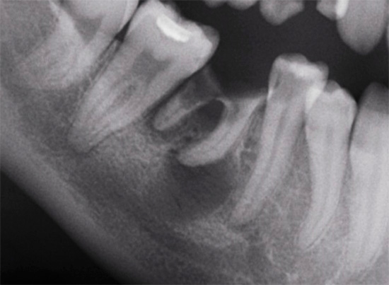 Así es como se ve la periodontitis en una radiografía (radiografía)