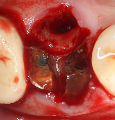 Si el médico por error no extrae al menos un trozo de la raíz del diente del orificio, entonces se puede formar un quiste alrededor de él.
