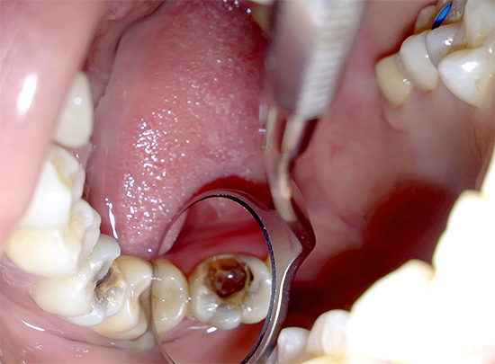 Betrachten Sie die wichtigsten Schritte, die das Verfahren zum Entfernen eines Nervs von einem Zahn bilden.