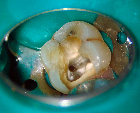 En las clínicas caras, el cofferdam se usa para aislar un diente enfermo de la boca.