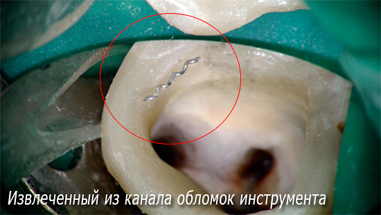 Das Foto zeigt ein Stück eines zahnmedizinischen Instruments, das aus dem Kanal entfernt wurde.