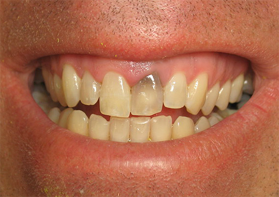 Parfois, après le traitement d'une pulpite, la dent peut foncer