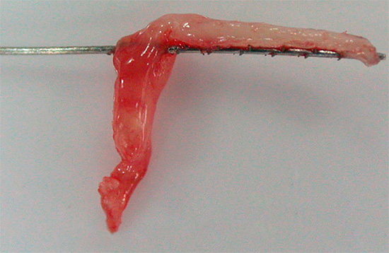 Foto eines Nervs, der vom Zahn entfernt wurde (Pulpa)