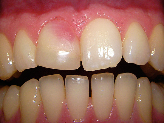 И тук е един пример за розов зъб, чийто цвят се дължи на използването на резорцин-формалинова паста за лечение на канал.