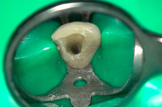 In der Regel wird der Mindestpreis nur bei der Behandlung von Pulpitis Einkanal-Zahn erhalten.