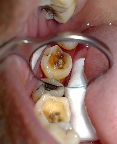 La foto muestra un diente cariado preparado para el tratamiento endodóntico.
