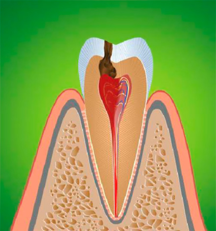 Η φλεγμονή του οδοντικού νεύρου οδηγεί σε πνευμονία, η οποία συνήθως συνοδεύεται από οξύ πόνο.