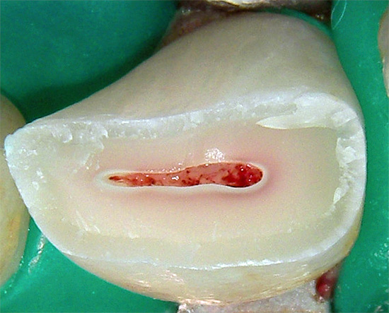 Снимката показва счупен зъб - също ще трябва да премахне нерв от него.