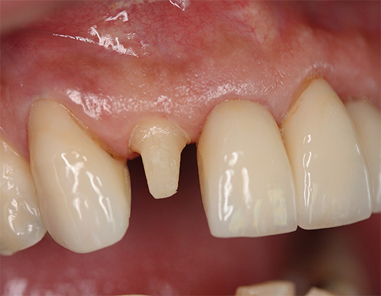 При подготовката на зъб за корона, тя често е предварително деполирана, но винаги ли е необходима? ..