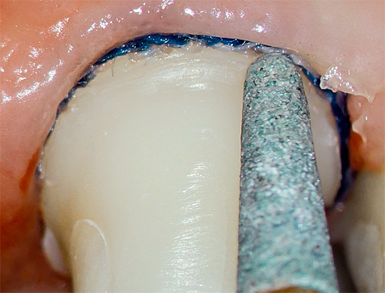 أثناء عملية طحن الأسنان تحت التاج ، يمكن أن يسخن العصب بداخلها ، مما يؤدي لاحقًا إلى التهاب لب السن.