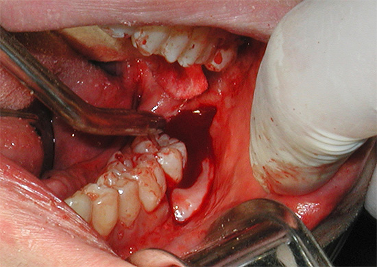 Il vantaggio dell'anestesia è la possibilità di manipolazioni indolori a lungo termine e traumatiche, ad esempio, associate alla rimozione complessa di un dente del giudizio.