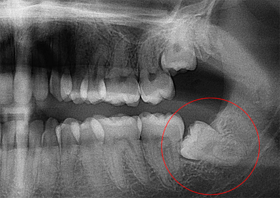 In questa radiografia, un dente del giudizio che si trova in modo errato nella mascella è ben visibile.