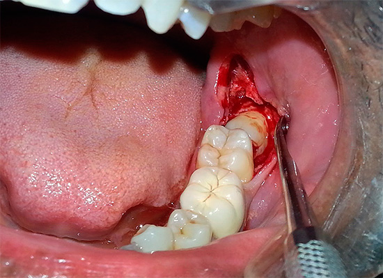 S'il s'avère que l'anesthésie est contre-indiquée pour vous, vous devrez alors enlever la dent de la manière habituelle - en utilisant une anesthésie locale.