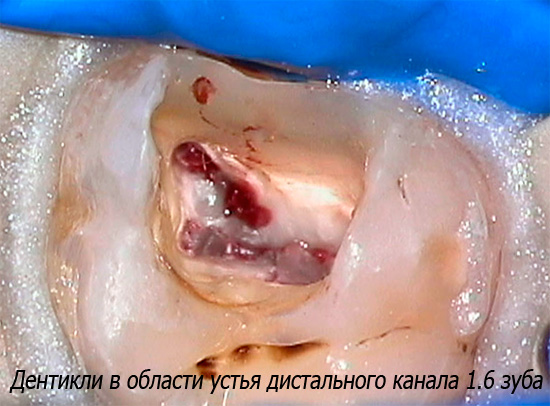 Dentikli в областта на устата на дисталния канал на зъба