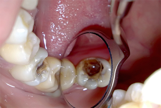 Един от най-трудните за практикуващия зъболекар е класификацията на пулпит според МКБ-10.
