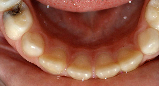 В повечето случаи пулпитът се дължи на инфекция на целулозата с бактерии, които проникват в зъба през кариесната кухина.