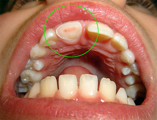 Травматичният пулпит е причинен от нарушение на стерилността на камерата за пулп, когато в резултат на отварянето му бактериите от устната кухина навлизат в нея масово.