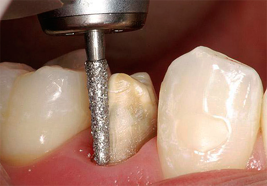 При смилането на зъб под короната, целулозата може да прегрее, което в бъдеще ще изисква и лечение ...