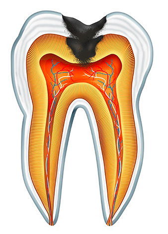 Cuando se aplica tópicamente, el medicamento funcionará solo en los casos en que exista una conexión entre la cavidad cariosa del diente y la cámara pulpar.