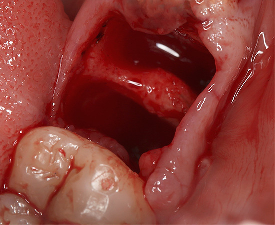 La consecuencia de la extracción de cualquier diente puede ser el sangrado prolongado del orificio ...