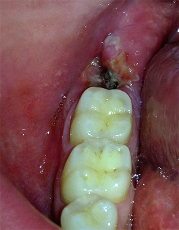 Un aumento de la temperatura también puede indicar una inflamación severa de la cavidad del diente.