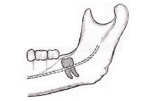 Cuando se extrae una muela del juicio en la mandíbula inferior, el nervio mandibular que pasa cerca a veces se daña, lo que conduce a la parestesia.