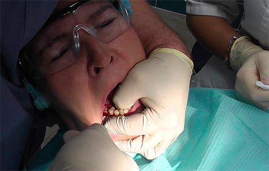 Dado que el médico aplica una cantidad considerable de fuerza en la extracción de un diente, deslizar el instrumento a veces provoca lesiones graves en el tejido blando circundante.