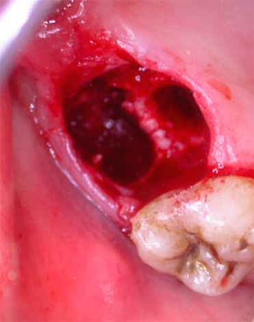 Un problema bastante grave que a veces ocurre después de la extracción de los dientes es la alveolitis, una inflamación de las paredes del agujero.