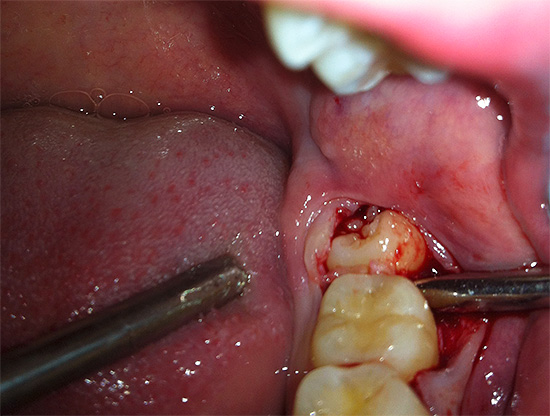 Στις περισσότερες περιπτώσεις, το όγδοο χαμηλότερο δόντι είναι πιο δύσκολο να αφαιρεθεί από τα οκτάρια στην άνω γνάθο.
