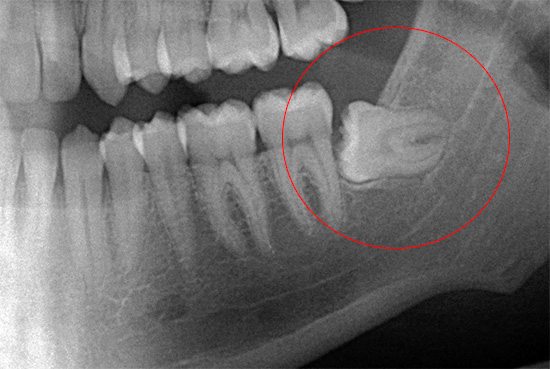 En la radiografía, se ve claramente cómo se encuentra la muela del juicio en la mandíbula, lo que facilita el trabajo del médico y reduce el riesgo de posibles errores.