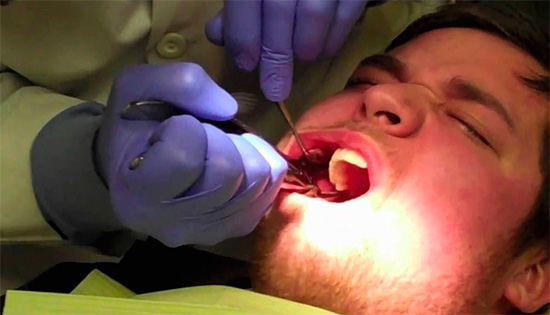 Entre las consecuencias desagradables de la extracción de muelas del juicio se encuentran varios errores médicos, hasta una fractura mandibular o la ruptura de la boca del paciente.