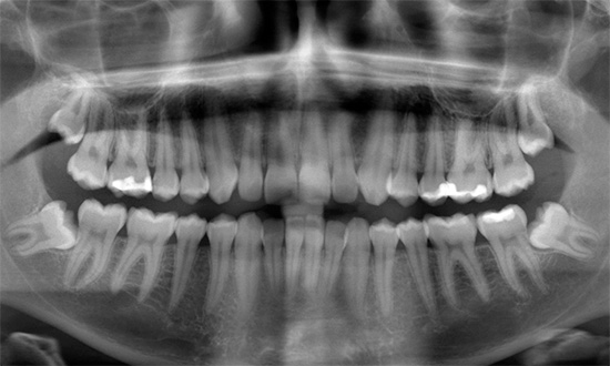 Τα εσφαλμένα αυξανόμενα δόντια σοφίας μπορούν να σπάσουν σημαντικά το δάγκωμα.