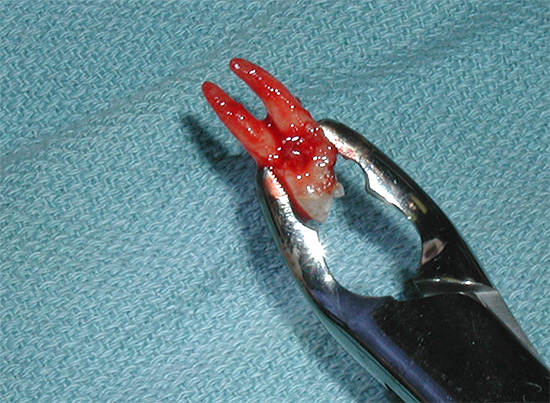 Con el ingenio y la habilidad adecuados, los cirujanos logran usar los fórceps de bayoneta para extraer los dientes superiores e inferiores.