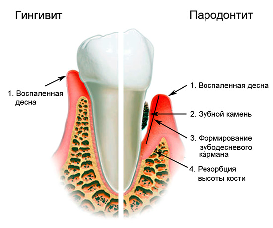 La imagen muestra la esencia de los procesos que ocurren con la encía y el tejido óseo durante la gingivitis y la periodontitis.