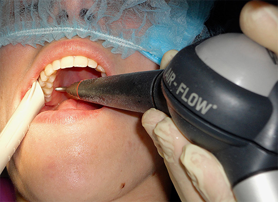 Al blanquear los dientes con la tecnología Air-Flow, no siempre es posible eliminar completamente el sarro.