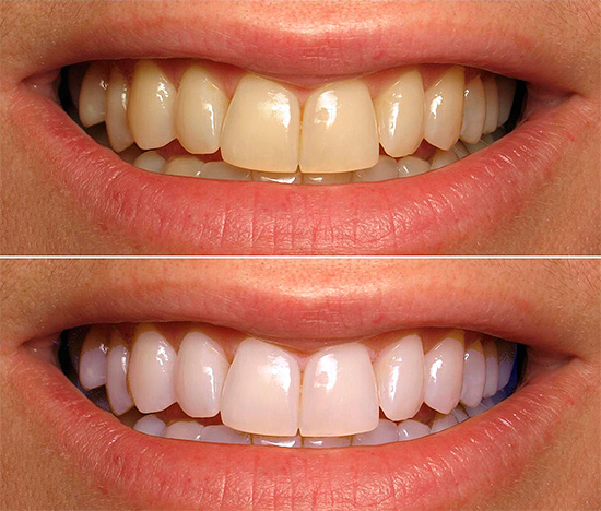 El blanqueamiento de los dientes del escritorio es la forma más efectiva (la foto muestra el estado del área de la sonrisa antes y después del procedimiento).