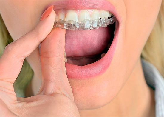 El uso de una tapa le permite prevenir los efectos del gel blanqueador en las encías.