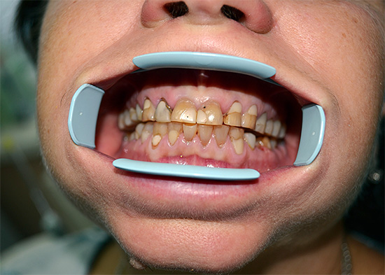 La presencia de un gran número de empastes y lesiones cariosas es una contraindicación para el blanqueo de los dientes por medios químicos.