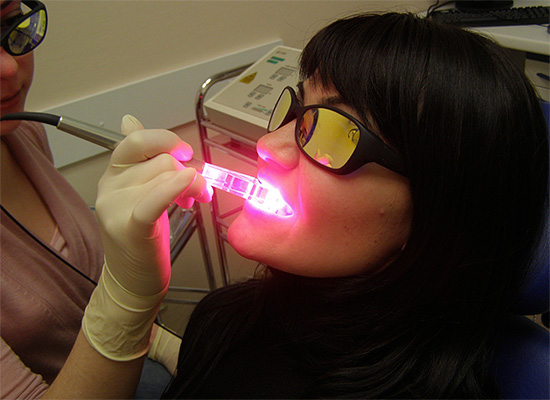 El blanqueamiento dental con láser es esencialmente químico, y el láser se usa solo como activador de compuestos de peróxido.