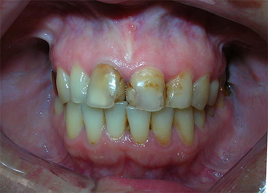 La presencia de rellenos antiguos en el método químico de blanqueamiento dental puede provocar la fuga del gel en las microfisuras, lo que a veces causa dolor intenso.