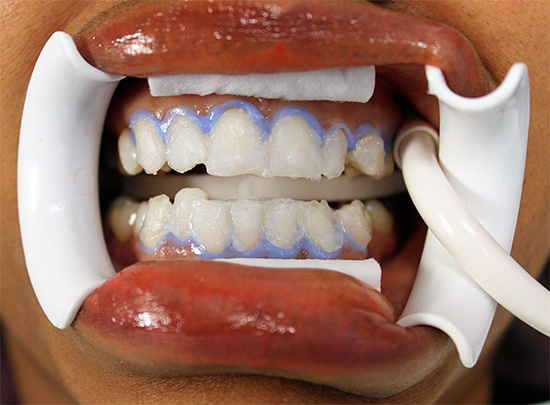 La foto muestra un ejemplo de blanqueamiento dental químico en el consultorio del dentista.