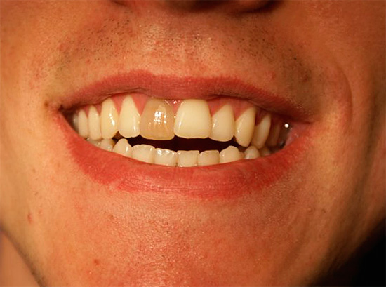 Foto de un diente muerto oscurecido antes del procedimiento de blanqueamiento.